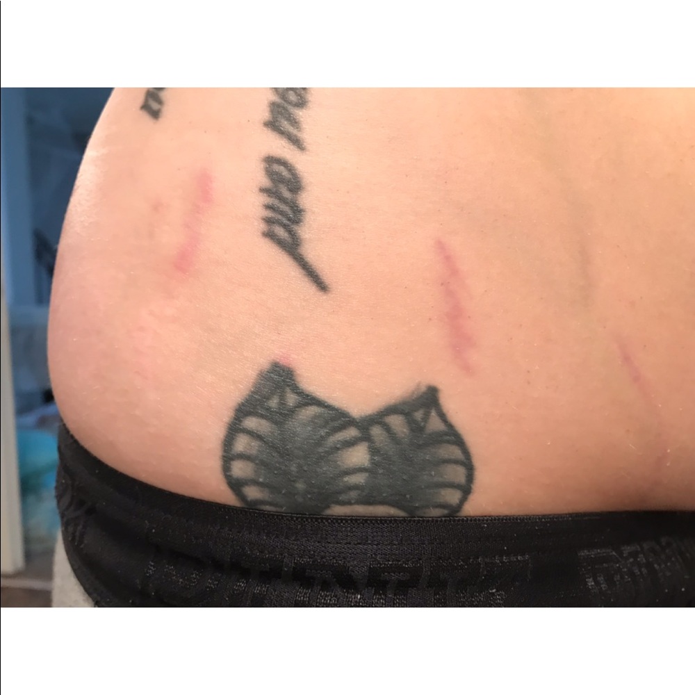 End of the Line: stretch mark disappearing lotion